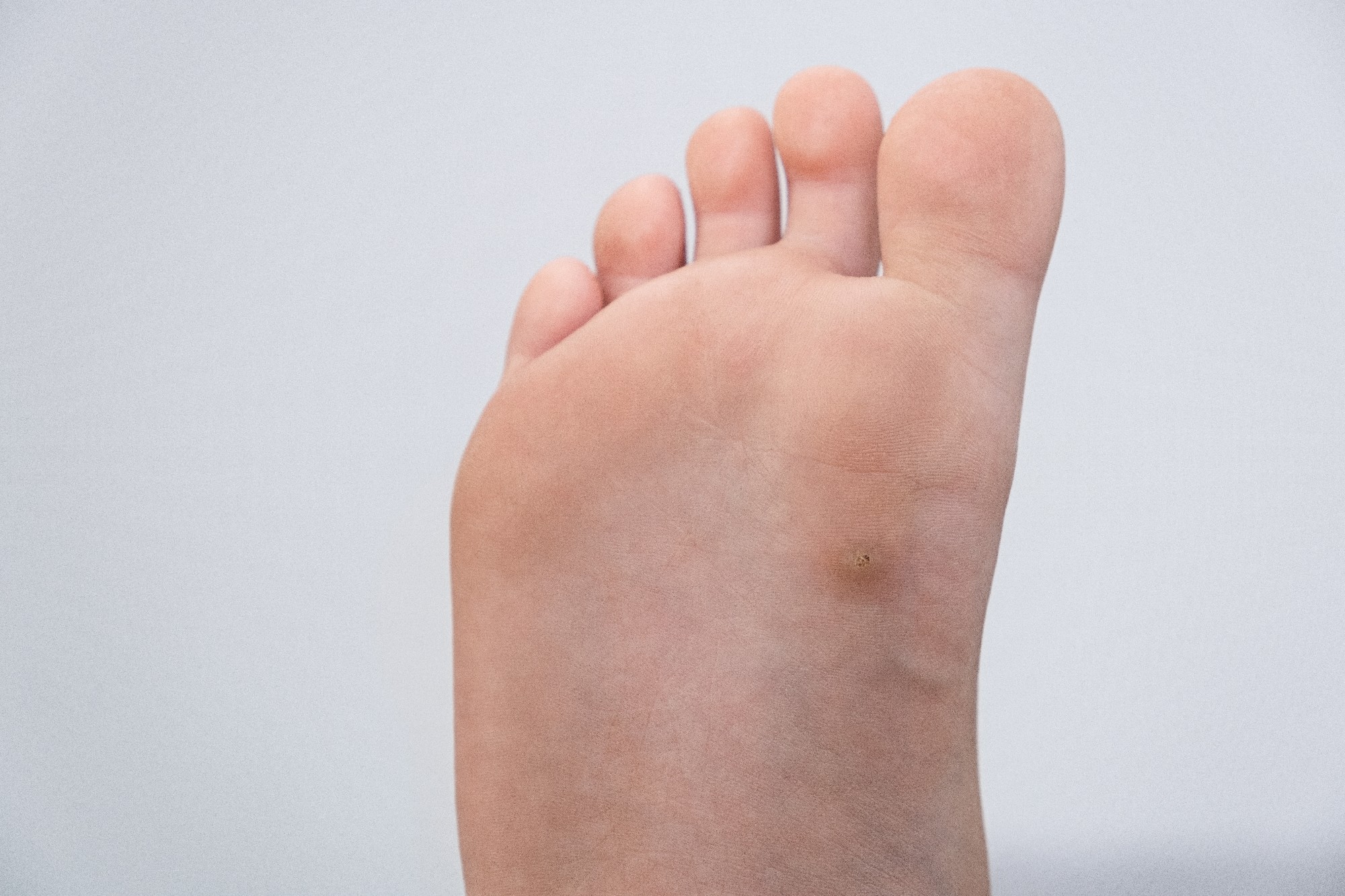 Wart, Papilloma On A Feet. Macro Shot, Selective Focus, Close Up